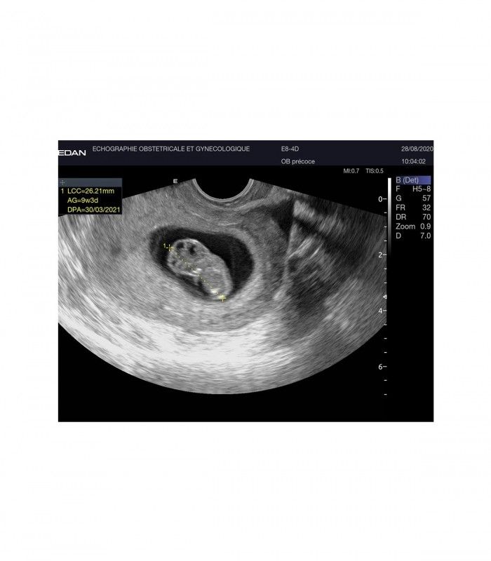 Échographes Echographe portable AX8 + 1 sonde