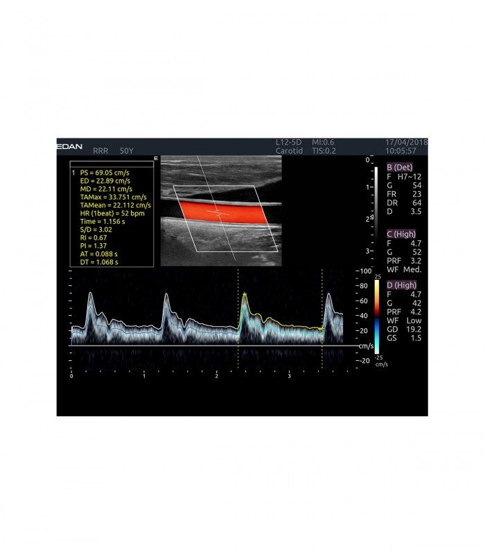 Échographes Echographe portable AX4 + 1 sonde